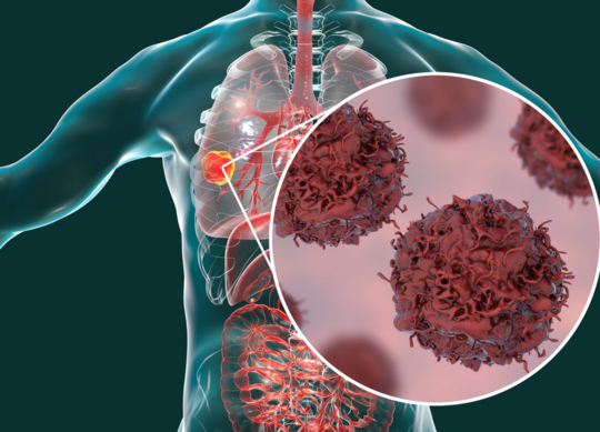 illustrasjon av ikke småcellet lungekreft